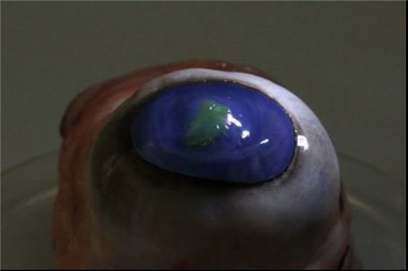 لنز چشمی که اشعه لیزر پرتاب می کند!
